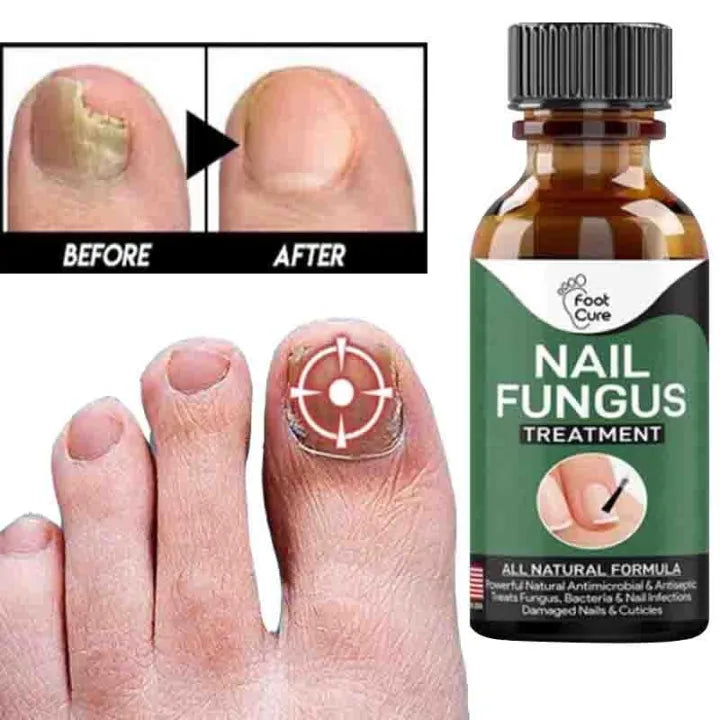 Nail Fungus Removal Gel