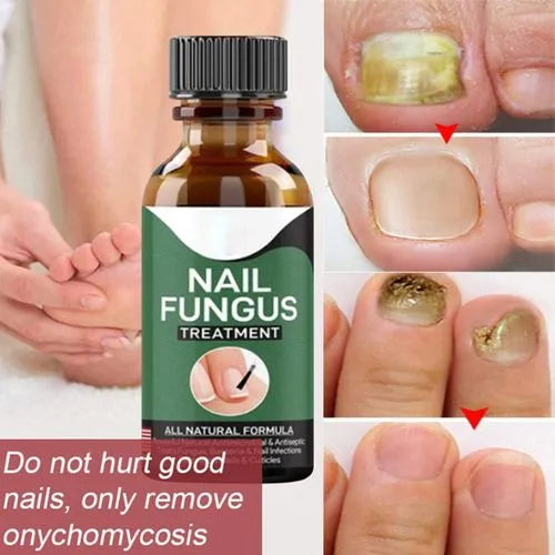 Nail Fungus Removal Gel